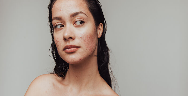 The Spiritual Meaning Of Acne Spirituality Health